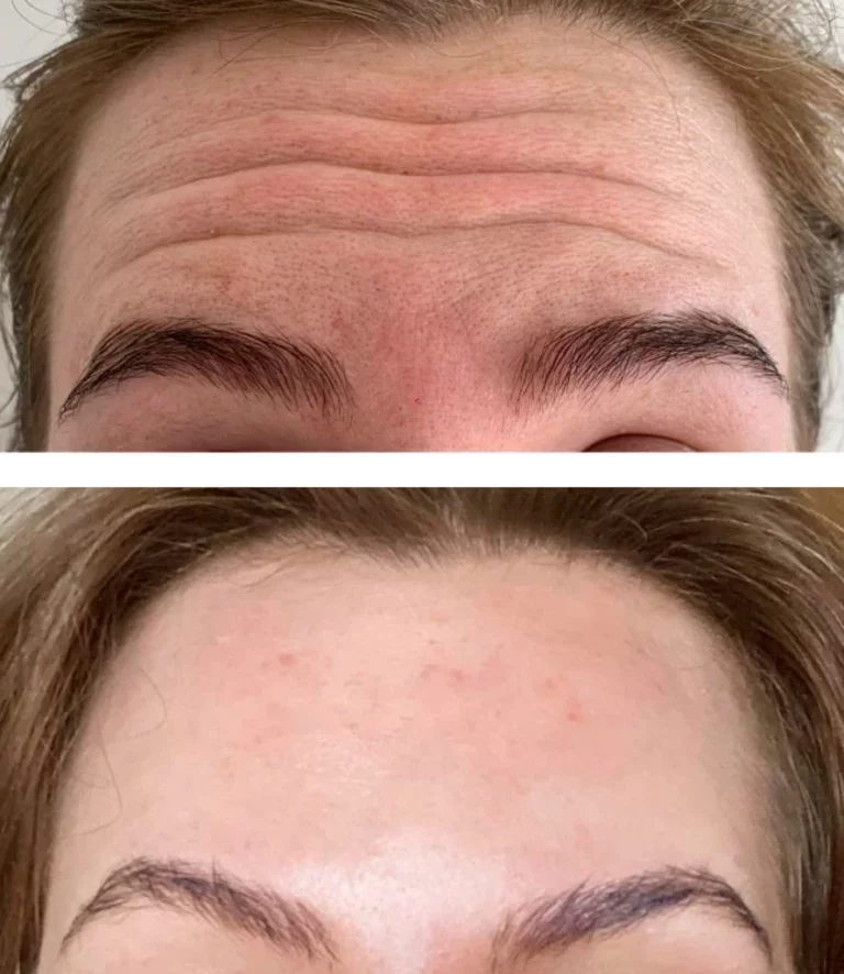 Exploring Brow Lifts with Dr. Laura Geige
